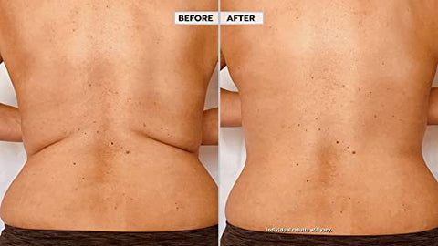 Instant Thigh Lift - Skinnies Instant Lifts – 5 Pares Levanta Costas – PATENTEADO MADE USA REDUZ GORDURA DAS COSTAS INSTANTANEAMENTE Fitas Adesivas Transparentes Suavizam Instantaneamente a Gordura das Costas. Use Decotes nas Costas!