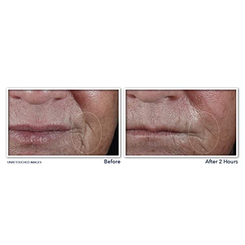 Retinol Correxion Adesivos Não Invasivos para Rugas Profundas com Ácido Hialurônico e Peptídeos Firmadores para Testa, Linhas de Expressão, Pés de Galinha e Risos (6 Adesivos) - RoC