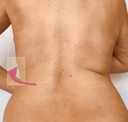 Instant Thigh Lift - Skinnies Instant Lifts – 5 Pares Levanta Costas – PATENTEADO MADE USA REDUZ GORDURA DAS COSTAS INSTANTANEAMENTE Fitas Adesivas Transparentes Suavizam Instantaneamente a Gordura das Costas. Use Decotes nas Costas!