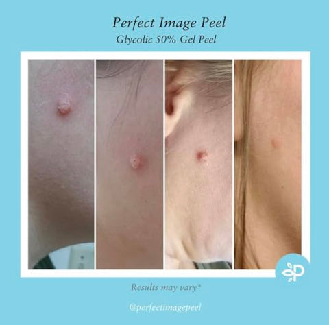 Perfect Image - Gel Peel de Ácido Glicólico 50% – Enriquecido com Retinol : [Nome da Marca]