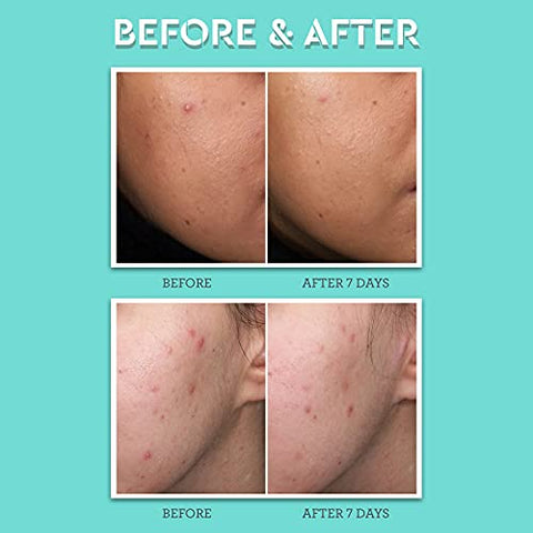 Tratamento para Acne Bliss Clear Genius – 15 ml – Ácido Salicílico 2%% – Reduz Manchas – Vegano