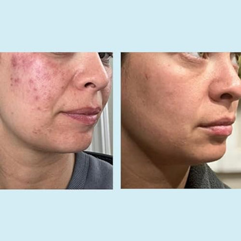 Perfect Image - Gel Peel de Ácido Glicólico 50% – Enriquecido com Retinol : [Nome da Marca]