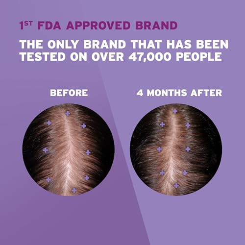 Solução Tópica 2%% Minoxidil para Queda e Afinamento Capilar Feminino 60ml | Tratamento Capilar Eficiente - Rogaine