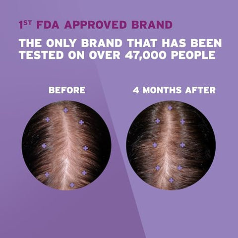 Solução Tópica 2%% Minoxidil para Queda e Afinamento Capilar Feminino 60ml | Tratamento Capilar Eficiente - Rogaine