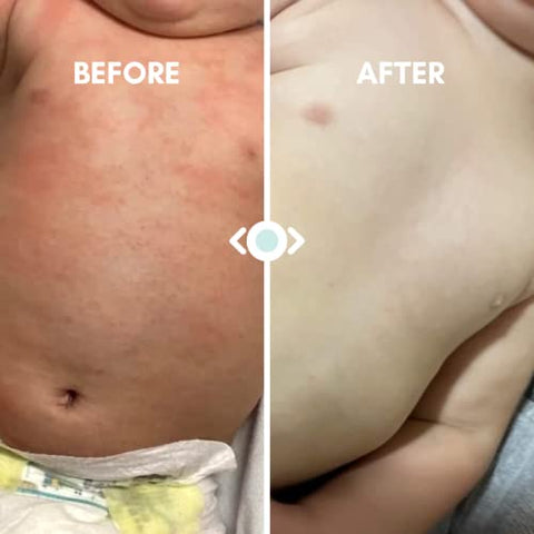 Pó de Banho de Aveia para Bebês com Eczema da Irene Organics – Aveia Coloidal para Tratamento Calmante de Eczema, Assaduras, Pele Seca, Coceira e Irritação – Hidrata e Alivia