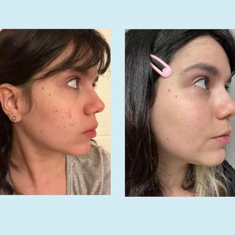 Perfect Image - Gel Peel de Ácido Glicólico 50% – Enriquecido com Retinol : [Nome da Marca]
