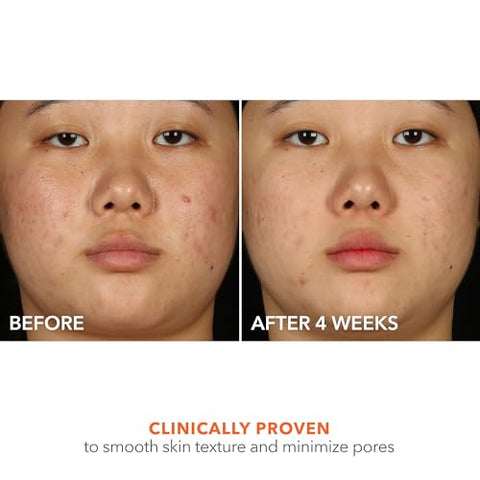 Alpha Beta® 2%% BHA Solução para Acne, Minimiza Poros, Clareia – 30ml - Dr Dennis Gross