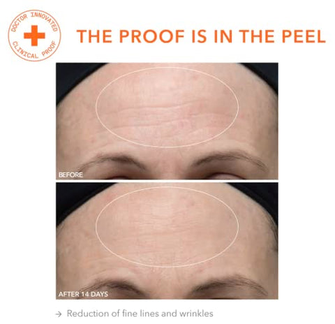Dr Dennis Gross - Dr. Dennis Gross Alpha Beta Ultra Gentle Daily Peel: Tratamento Diário Suave para Pele Desidratada ou Sensível, Tom ou Textura Irregulares, Linhas Finas ou Poros Dilatados (5 Tratamentos)