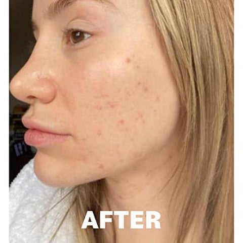 Pore Favor - POREFAVOR – Suplemento para Acne com DIM e Zinco 10 ativos, combate as 4 fases do desenvolvimento da acne. Vitaminas para Pele Limpa, Manchas e Imperfeições