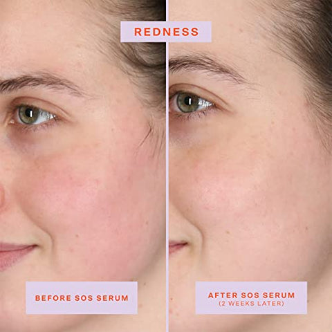 SOS Serum Intensivo de Resgate para Pele Sensível, Cuidados com a Pele com Ácido Hipocloroso, Alivia Irritação, Ajuda a Reduzir Vermelhidão Facial, 60 ml - Tower 28