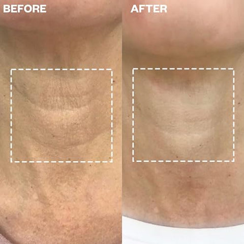 Wrinkles Schminkles - Patches de Silicone Reutilizáveis para Rugas no Pescoço – Redução de Rugas – Tratamento Inovador – Alvo de Rugas – Pads Suavizantes Sensíveis –