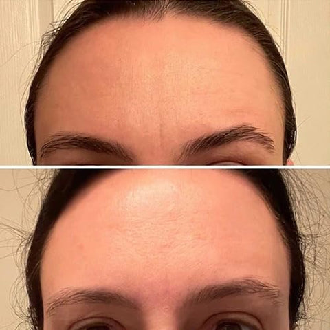 FROWNIES - Frownies Forehead – Kit com 2 Itens: Redutor de Rugas Facial – 30g