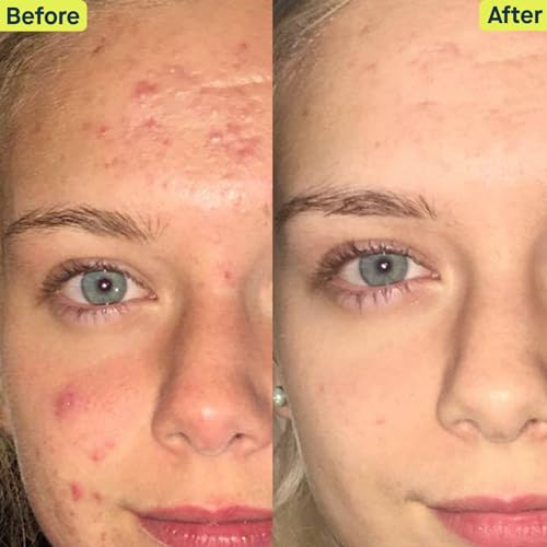 Skincare by Dr. Pimple Popper – Kit 4-peças para Acne – Sistema de 30 dias – Rotina completa de 3 passos, 2x ao dia para tratar e prevenir todas as fases da acne - SLMD