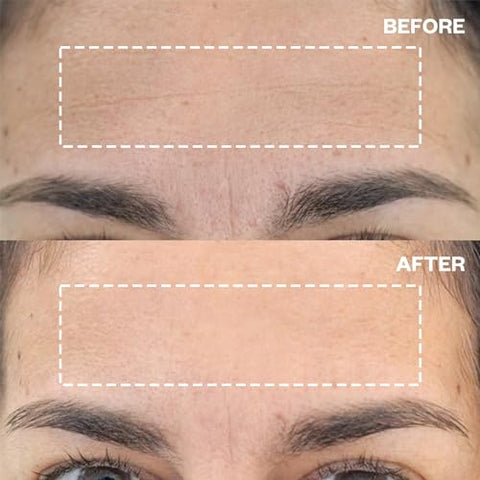 Patches de Silicone Reutilizáveis Wrinkles Schminkles para Rugas na Testa – Suavizadores de Rugas, Levantamento de Sobrancelhas, Reduz Linhas de Expressão