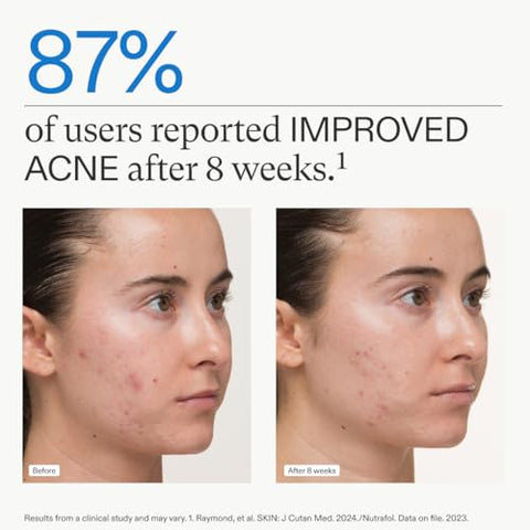 Clear Skin – Suplemento para Acne em Mulheres, Testado Clinicamente para uma Pele Mais Clara e Suave, Fórmula Médica, Vegano – 1 Mês de Fornecimento - Nutrafol