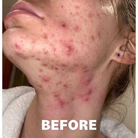 Pore Favor - POREFAVOR – Suplemento para Acne com DIM e Zinco 10 ativos, combate as 4 fases do desenvolvimento da acne. Vitaminas para Pele Limpa, Manchas e Imperfeições