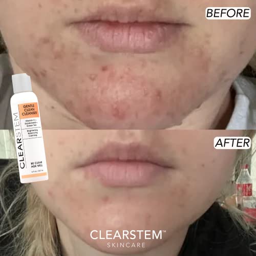 GENTLECLEAN Vitamina C Infundido Limpador Calmante – Removedor de Maquiagem – Chá Verde de Hydrastis – Produtos para Cuidados com a Pele do Rosto – Vegano, Sem Glúten, Sem Crueldade – 100ml - CLEARstem