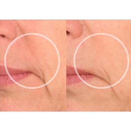 LipLift Patches – Redutor de Rugas Noturno para Lábios  SiO - SiO