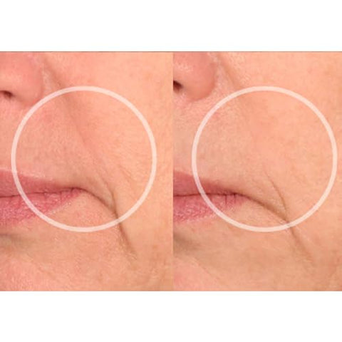 LipLift Patches – Redutor de Rugas Noturno para Lábios  SiO - SiO