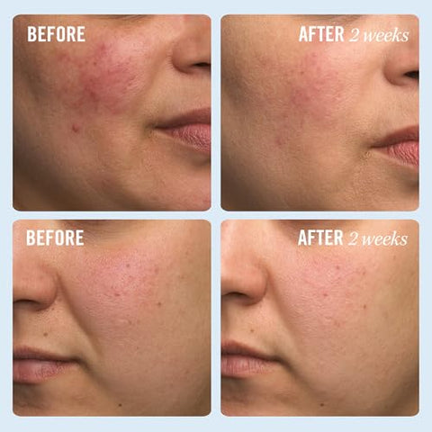 Ultra Repair Cream – Hidratante Intenso para Rosto e Corpo – Fortalece a Barreira da Pele, Alivia Instantaneamente a Pele Seca e Eczema – 6 oz Bônus (177 ml) - First Aid Beauty