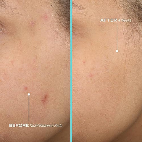 Facial Radiance Pads – Pads Diários Esfoliantes com AHA que Auxiliam no Tônus Facial | Primeiros Socorros para a Pele - First Aid Beauty