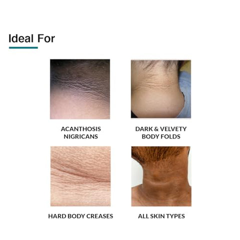 Nigrifix Creme para Acanthosis Nigricans com Ácido Lático | Creme com Retinol Testado por Dermatologistas | Útil para Partes Escuras do Corpo como Pescoço, Tornozelos, Axilas | 50g - FIXDERMA
