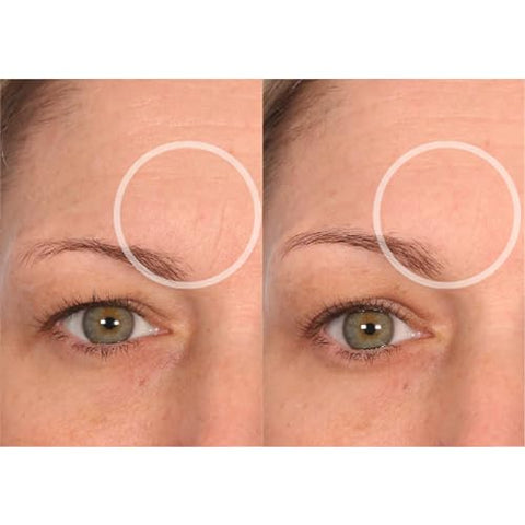 Beauty BrowLift – Adesivo Anti-Rugas para Testa – Suavização de Linhas de Expressão – Silicone de Grau Médico para Redução de Rugas Durante a Noite - SiO