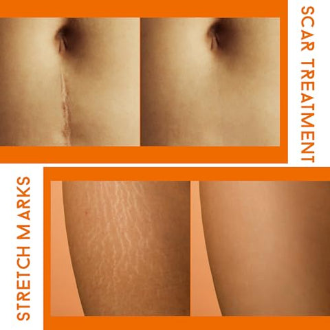 Creme Removedor de Cicatrizes ABERA Red Turmeric (Produto Premium) – Tratamento Avançado para Rosto e Corpo com Ingredientes Naturais Remove Rapidamente Estrias, Queloides, Queimaduras e