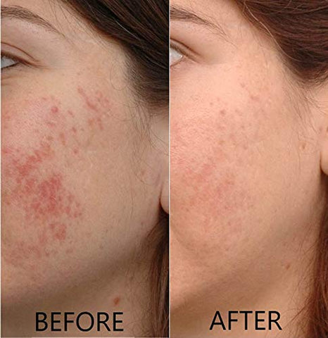 Dr. Brenner - Soro de Vitamina C 20% Ácido L-Ascórbico Puro, Ácido Ferúlico, Vitamina E e Ácido Hialurônico com Vitamina B5 para Rosto e Olhos – Conjunto Natural Anti-Envelhecimento e Anti-Rugas de 2 unidades pela [nome da marca]