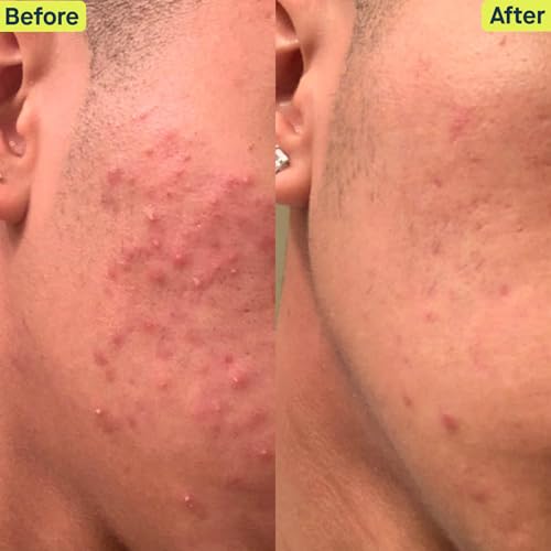 Skincare by Dr. Pimple Popper – Kit 4-peças para Acne – Sistema de 30 dias – Rotina completa de 3 passos, 2x ao dia para tratar e prevenir todas as fases da acne - SLMD