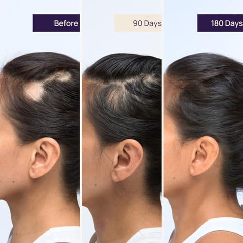 WELLBEAUTY - OMI Hair Nutrition: Suplemento para Crescimento Capilar Feminino, Comprovado Clinicamente para Crescer Cabelos, Reduzir Queda Capilar, Fórmula Médica para Cabelos Mais Fortes e Mais Espessos com Queratina e Biotina