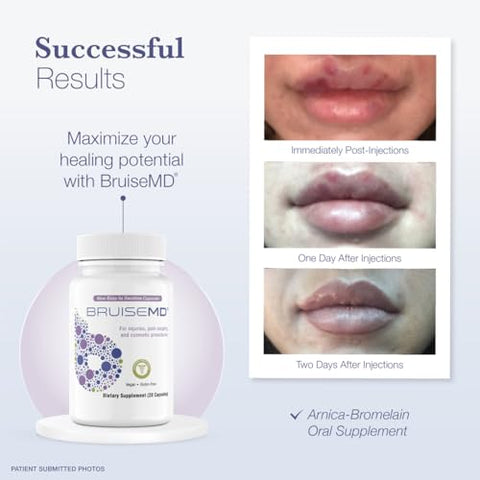 BruiseMD - Suplemento Arnica 1.000mg e Bromelina 500mg 2.400GDU/g para Hematomas e Inchaços, Cápsulas Fáceis de Engolir (Fornecimento de 7 Dias)