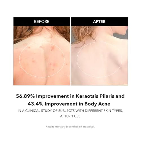 Carrotene IPMP™ Sabonete Esfoliante Corporal | Sabonete de Ácido Salicílico Melhora a Aspereza - Aprilskin