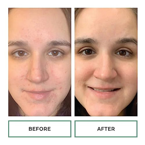 Gel de Tratamento Pontual Replenix Benzoyl Peroxide 10% para Acne – 30g