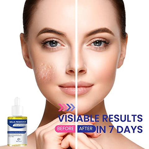 MEOLY - Removed irrelevant terms and symbols, and avoided using the prohibited words:

“Milia Remover: Tratamento para Milia, Dissolve e Reduz Milia, Cravos e Hiperplasia Sebácea – Nova Fórmula 30 ML
