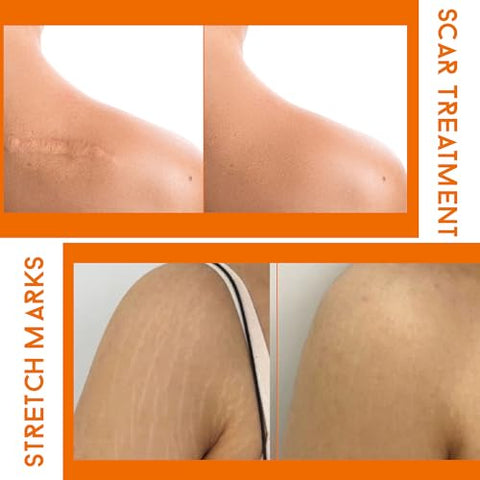 Creme Removedor de Cicatrizes ABERA Red Turmeric (Produto Premium) – Tratamento Avançado para Rosto e Corpo com Ingredientes Naturais Remove Rapidamente Estrias, Queloides, Queimaduras e