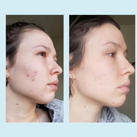 Perfect Image - Gel Peel de Ácido Glicólico 50% – Enriquecido com Retinol : [Nome da Marca]