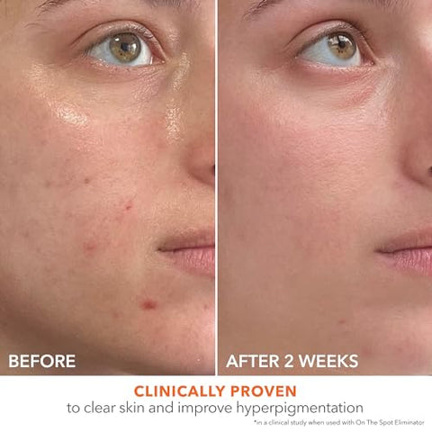 Alpha Beta® 2%% BHA Solução para Acne, Minimiza Poros, Clareia – 30ml - Dr Dennis Gross