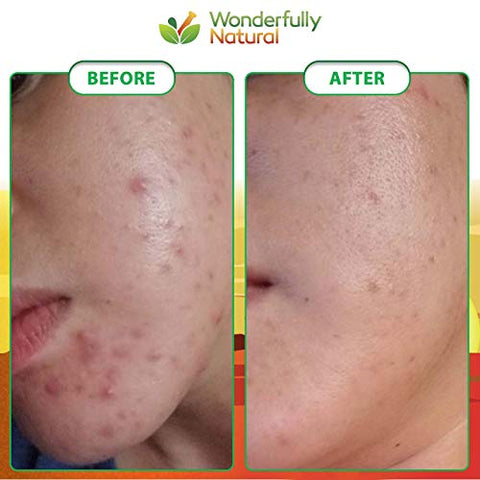 Wonderfully Natural - Sabonete Negro Africano Orgânico – Para Acne : [Nome da Marca]