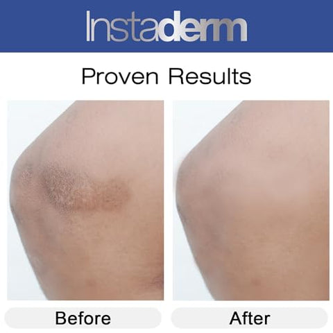Instaderm - Creme de Vitamina K – Fórmula de Cicatrização de Hematomas com Arnica. Hidratante para Manchas Escuras causadas por Hematomas e Vasinhos