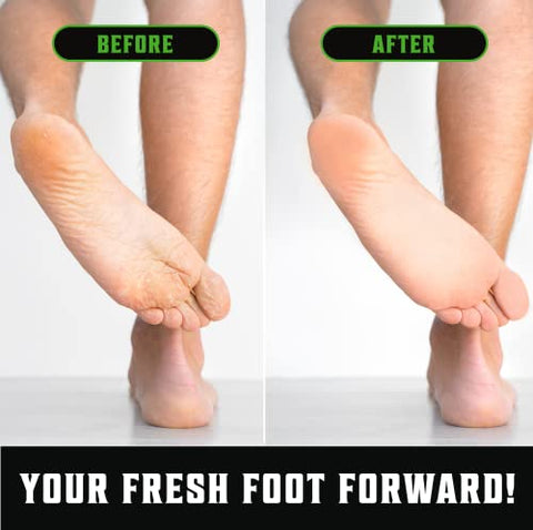 Sabonete Viking Revolution Tea Tree Oil para Homens – Combate Pé de Atleta, Fungos nas Unhas, Coceira na Virilha, Eczema, Tinea Corporis