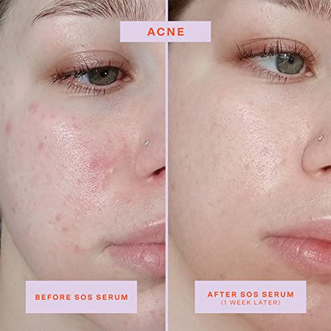 SOS Serum Intensivo de Resgate para Pele Sensível, Cuidados com a Pele com Ácido Hipocloroso, Alivia Irritação, Ajuda a Reduzir Vermelhidão Facial, 60 ml - Tower 28