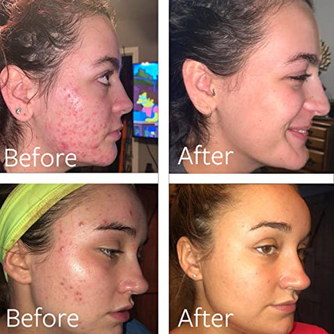 Dr Song - Benzoyl Peroxide Wash 10%: Tratamento para Acne – Sabonete Facial para Acne – 100g