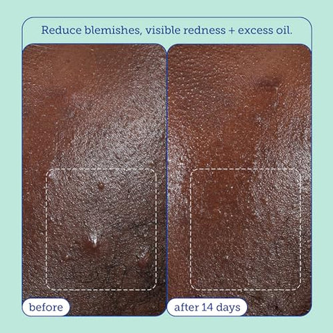 Acne BHA Cleanser: Limpeza Profunda dos Poros em Vários Níveis  Skinfix - Skinfix