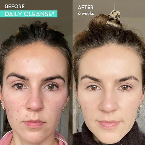 Daily Cleanse – Suplemento para Acne e Pele Limpa | Marca HUM - HUM