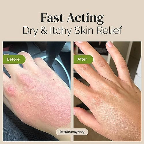 Creme Puriya Aprovado pela Associação Nacional de Eczema 4.5 oz, Alívio para Pele Seca e Coceira, Loção de Aveia Coloidal, Para Crianças, Adultos, Rosto, Mãos, Mãe de Todos os Cremes, à Base de Plantas – Compre Agora!