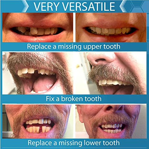 Kit de Substituição Temporária de Dente Instant Smile Complete Your Smile – Substitua um Dente Ausente em Minutos – Patenteado
