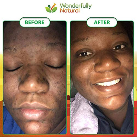 Wonderfully Natural - Sabonete Negro Africano Orgânico – Para Acne : [Nome da Marca]