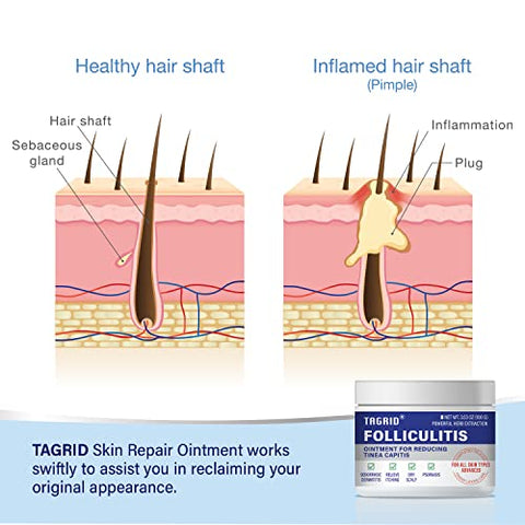 TAGRID - Tratamento para Folliculitis – Creme para Folliculitis, Tratamento Severo, Líquen – Seguro – 100g