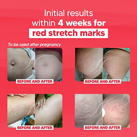 Red – Fórmula Inovadora para Remoção de Estrias Vermelhas e Roxas – Ingredientes Naturais Poderosos da Flora Brasileira – Para Todos os Tipos de Pele - Cicatrissim